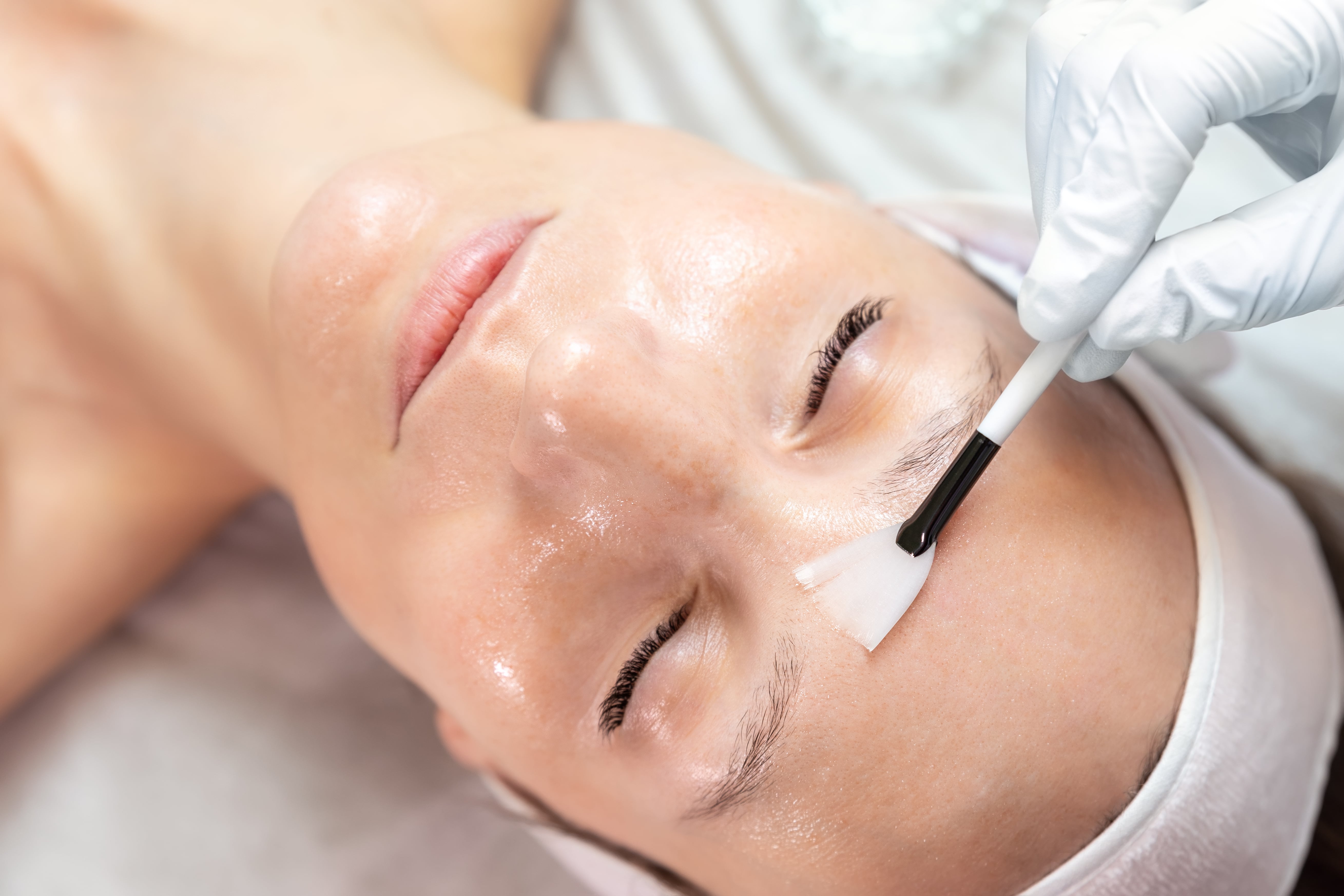 Hormonal Acne Treatment At Aesthetic Beauty By Lorraine